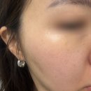 (주)서울레이저 인돈식 | 서울 편평사마귀 무제한 성지 편평사마귀 제거 co2레이저 내돈내산 후기