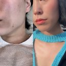 타이트짐 | 부산 신상 리프팅 올타이트 400샷 뷰린이 후기 즉각 효과? (온다리프팅?!)