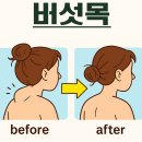 목정 | 버섯목 치료 효과가 멈춘 것 같다면? 정체기일 수 있습니다 (feat. 다이어트와 비슷한 이유)