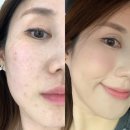 리참성형외과의원 | 리참성형외과 트리필프로 스킨부스터(쥬베룩) 솔직 후기