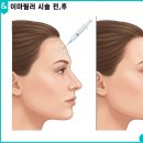 박지민헤어 | 일산이마필러 실패 안하려면 '이것' 꼭 확인하세요
