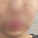 인천 구월동피부과 리쥬란힐러+바이리즌 속건조 해결한 후기
