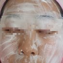 순마음의원 | 중랑구 미앤지의원 편평사마귀 제거 | 비용·통증·1일차 후기