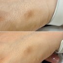 차뷰티 | ​일산 백석동 피부톤 개선 클리어스팟 3회차 후기 | 미작뷰티 2탄
