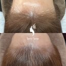 스킨새로이 | 파주 운정동에서 소문 듣고 왔어요! 일산 주엽동 새로이숲 헤어라인 문신, 자신감 되찾은 솔직 후기