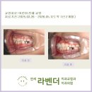 여의도 교정 연세라벤더치과 "6월 어린이 교정 후기"