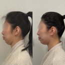 (주)마이크로투매크로 | [성동] 이중턱 제로프팅 왕십리 디유에스테틱