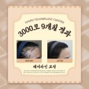 길어진 인생 올바른 자산관리 | 전주 모발이식 후기 통증과 회복 과정은 어떨까