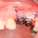 강동씨엘치과의원 | 치과 공포 줄어든 방문 허니플란트치과의원 스케일링 검진 만족 후기