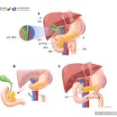 췌장암(pancreatic cancer) 이미지