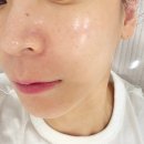 [마곡 트러블 관리] 마곡 피부시대에서 피부과 시술 후 맞춤케어 후기