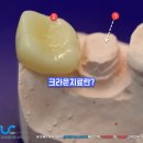 길음 서울미디어문화마루 | 길음역치과 크라운치료란?