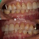 부곡치과병원 | 의왕 치과 내 치아가 시린 이유는 치경부 마모증 때문이다? 시린이 레진 치료 후기