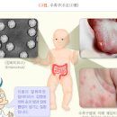 영유아가 자주 걸리는 수족구 증상 및 원인과 치료법 : 성인 아기 이미지