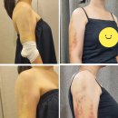멍순이 | 워킹맘의 송파다이어트 팔뚝 지방주출주사 후기 2주차