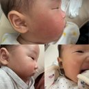 한마음약국/한마음몰 | 미라클뮤즈 히알세라크림 피부과화장품, 신생아두드러기피부 비포애프터 생생후기! :)