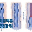 천안세브란스의원 | 천안하지정맥 시술 후 부작용 '이것' 제대로 안해서 생깁니다
