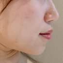 자연스러운입술필러 청담피부과 입술필러 후기