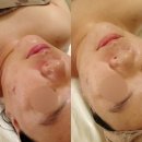 성남대로172번길 | 미금역 피부관리 듀에스떼 | 듀글로우리프팅 후기