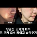 내돈내산 코모공레이저 후기 / 축소 흉터 효과 공텐자 후 mla레이저
