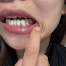 잇몸내려앉음영양제 3개월 챙기니 눈에 띄게 달라진 후기
