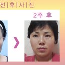 브이라인