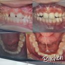 더탑치과교정과치과의원 | 악궁확장장치 초등아이 비포애프터 부천 더탑교정치과