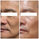 (주)라마라 | 개복치 여드름 피부의 모공/탄력/팔자주름 고민해결한 찐!! 시너지 라마라 무자극 PDRN 앰플
