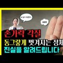 손바닥 발바닥 각질 벗겨지는 박탈성 각질융해증 원인/증상/관리 한번에 총정리! 이미지