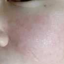 리얼 | 부산 리쥬란 리얼 후기 연산동 피부과 전후 비교