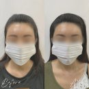라인 | 안산두피문신, 자연스럽게 달라진 헤어라인 후기