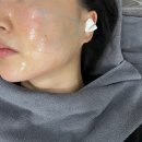 광천통뒤 - 좌 | 부산 서면 이중턱 온다리프팅 잘하는곳 내돈내산 후기