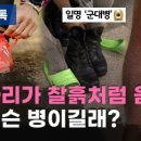 [리빙톡] 엄지로 누르자 점토처럼 움푹…무슨 병이길래? 이미지