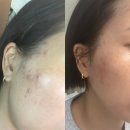 제이타워 | 평촌피부관리 피부가 뒤집어졌다면? 에스떼제이 안양평촌점 '피부를 리셋하다' 후기