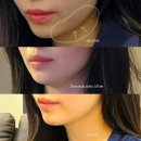 초이성형외과 | ✨ 온다리프팅60kj+얼굴 윤곽주사 후기 | 봄 되기 전에 얼굴 정리 완료
