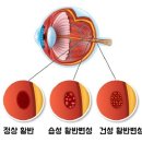 오십 넘었다면, 눈 속 '황반' 건강도 챙겨야 할 때 이미지