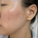 WR(서울특별시 강서구)-[마곡중앙10로]-상-1 | [마곡에스테틱]좁쌀 여드름 피지 압출관리 슈퍼젝션 3일차 시술 경과 후기
