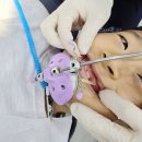 어린이 부정교합 치아교정 평택교정치과 서울e라인교정치과