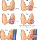 갑상선암의 병기판정; 2017년 개정된 AJCC 8th edition 이미지
