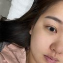 희봉선생 | 팔자주름리프팅 가장 효과봤던 네오스컬프리프팅 2회차 후기