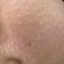 예쁨주의쁨의원 | 천안 스킨부스터 [예쁨주의쁨의원 천안점] 필로드 맞아본 후기