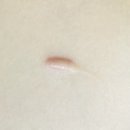진진약국 | [맹장수술 8개월차] 맹장수술 흉터 복강경수술 흉터 근황