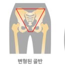 골반교정 필라테스 이미지