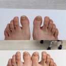 파리바게뜨(장안배봉) | 바아오풋케어 장안점 내성발톱교정후기