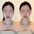 명지 윤곽관리 휘담에스테틱 V핏윤곽 예신관리 후기