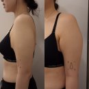 다온푸드 365MC점 | 365mc 교대점 팔뚝 무한람스 내돈내산 후기 (1) 시술 직후~3일차