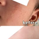 수만 | 아기 태열 언제까지 기다릴수만 없어요ㅠㅠ 관리 후기(B&amp;A)