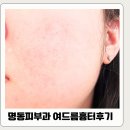 내돈내산 명동역피부과 여드름흉터시술 SRS레이저 한달후기