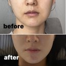바른길치과의원 | 10년 된 턱 비대칭, 교정 6개월 만에 해결한 후기