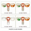 경희보궁한의원 | [난소낭종/난소낭종치료] 2달동안 경희보궁한의원에서 난소낭종치료받은 후기입니다.^^